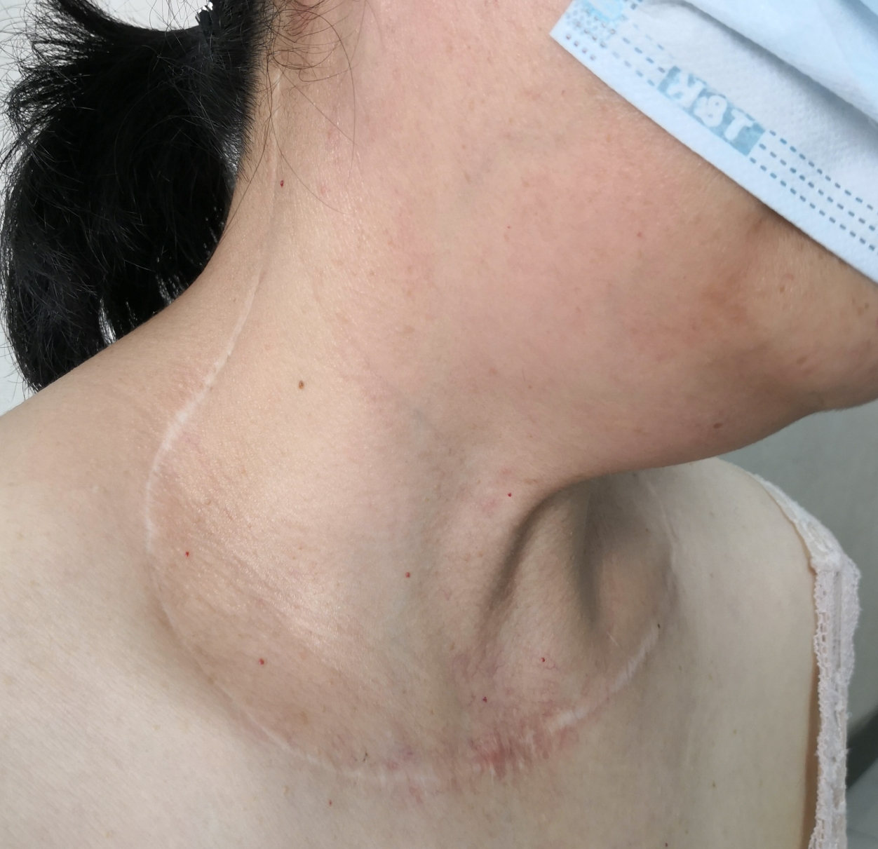 甲状腺癌单侧颈清扫手术,纵矩形切口.