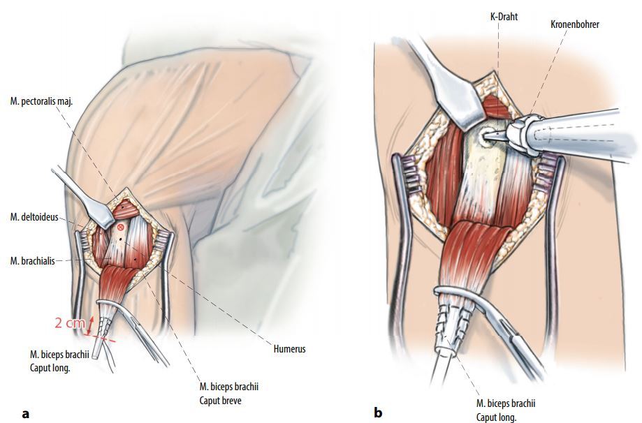 上图:肩关节疼痛肩关节前方撞击征存在冈上肌肌腱损伤撕裂的