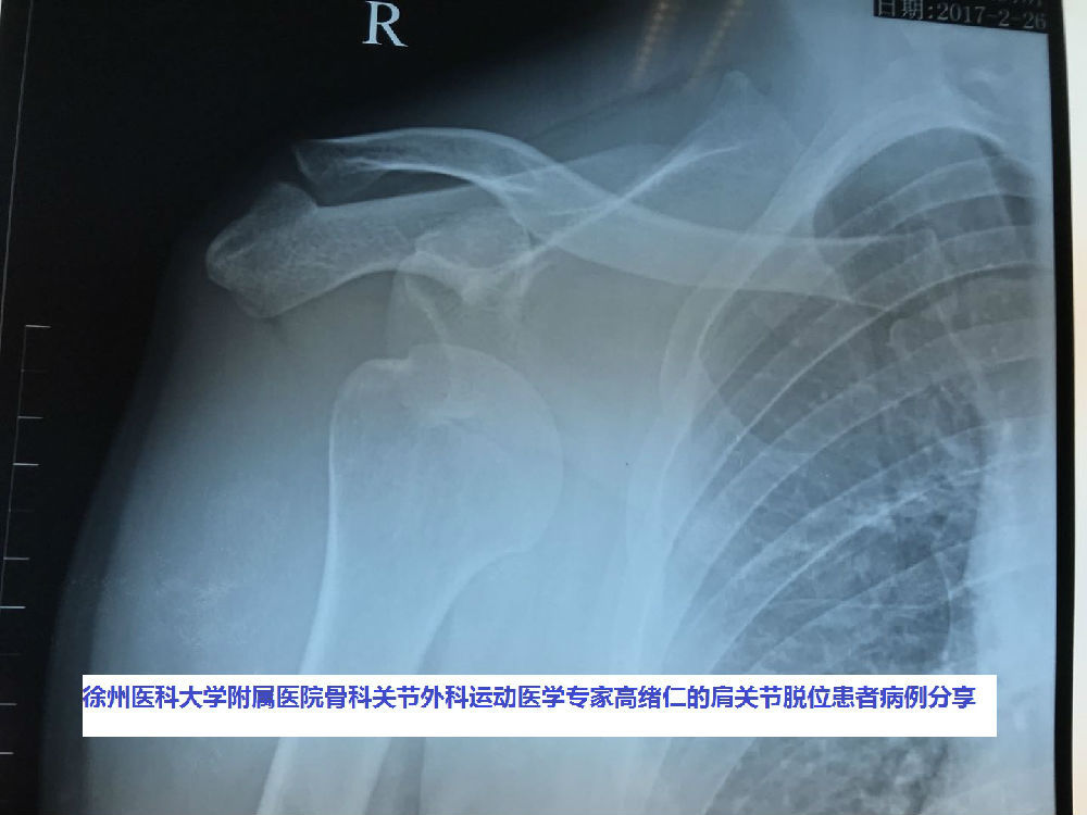 肩关节品牌专家高绪仁为您讲解十大原因.