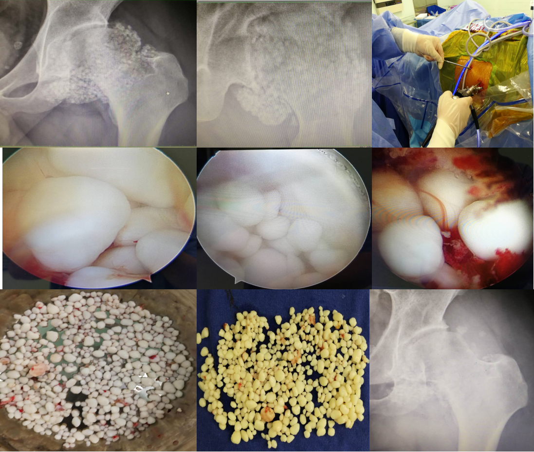 髋关节内取出500多颗