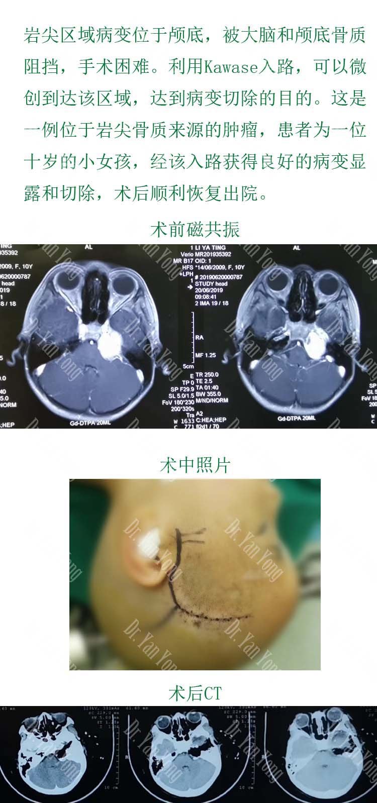 经kawase入路微创切除颅底肿瘤