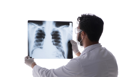 特发性肺纤维化是什么病