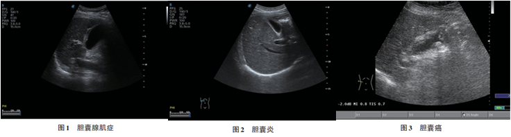 胆囊壁增厚是怎么回事