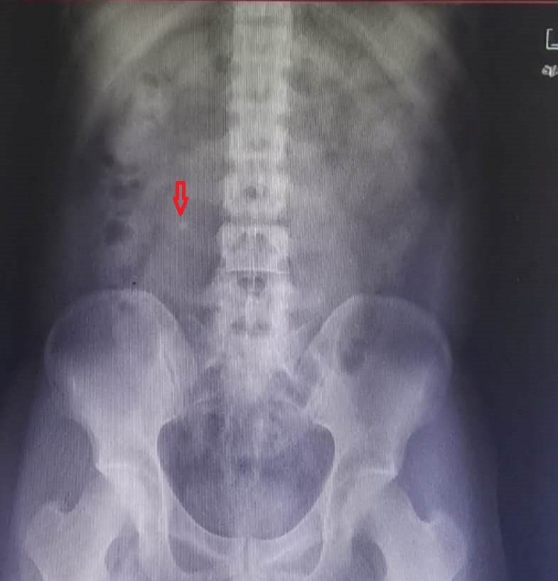红箭头所示为术前右输尿管上段阳性结石(因为有些阴性结石在x光下是