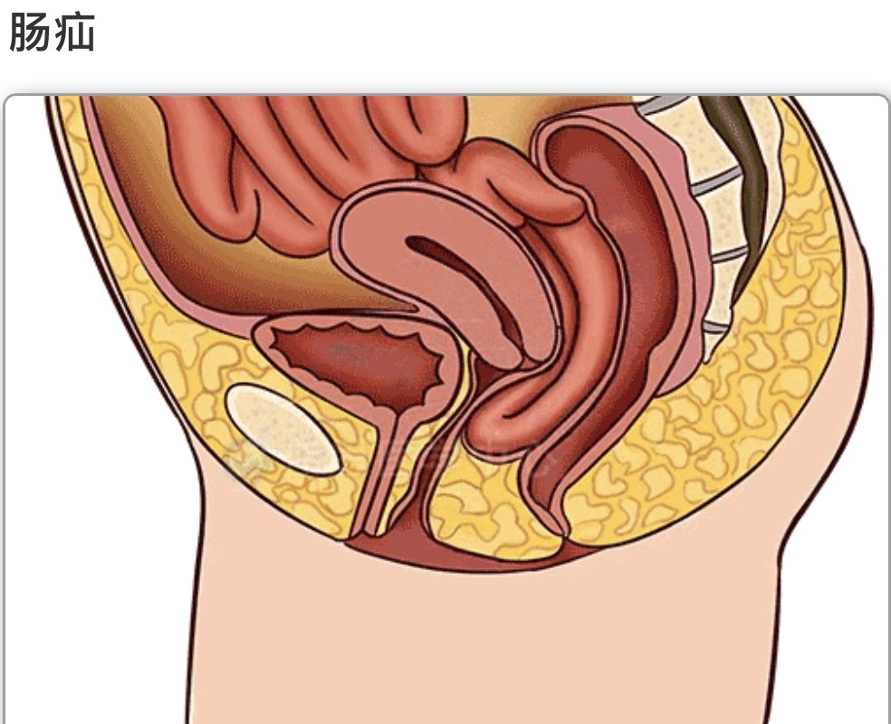 这种疾病常常与前骨盆松弛相关联,往往引起膀胱膨出和膀胱尿道膨出.