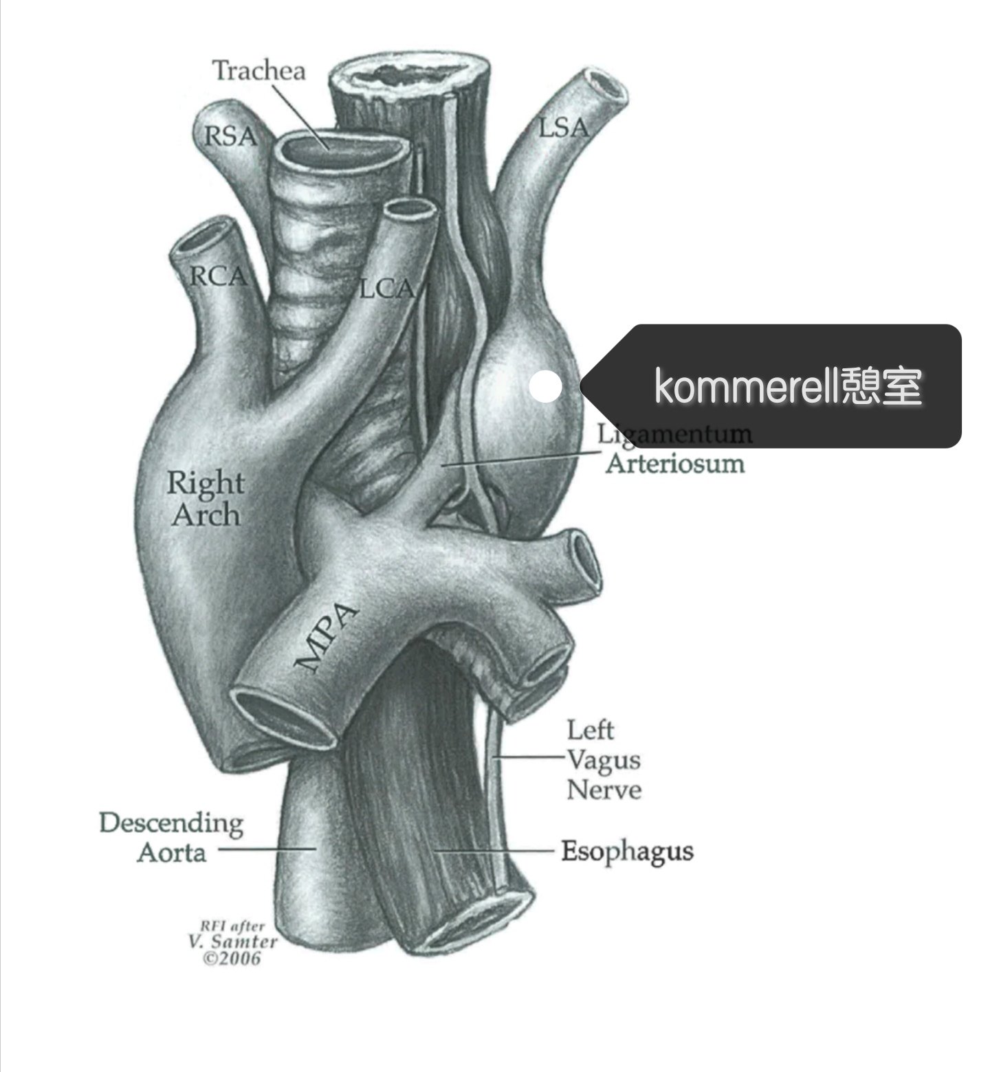 kommerell憩室切除kommerell憩室,锁骨下动脉与左颈总动脉吻合.