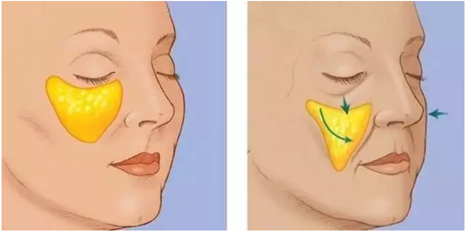 颧脂肪垫随年龄的变化是导致面中部老化的主要因素之一.