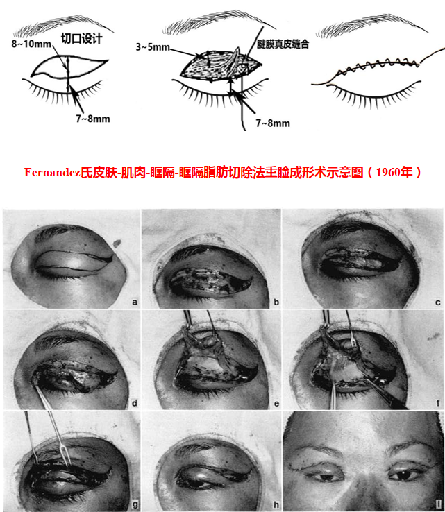 我国眼整形行业面临的问题与挑战 (一)双眼皮手术发展史