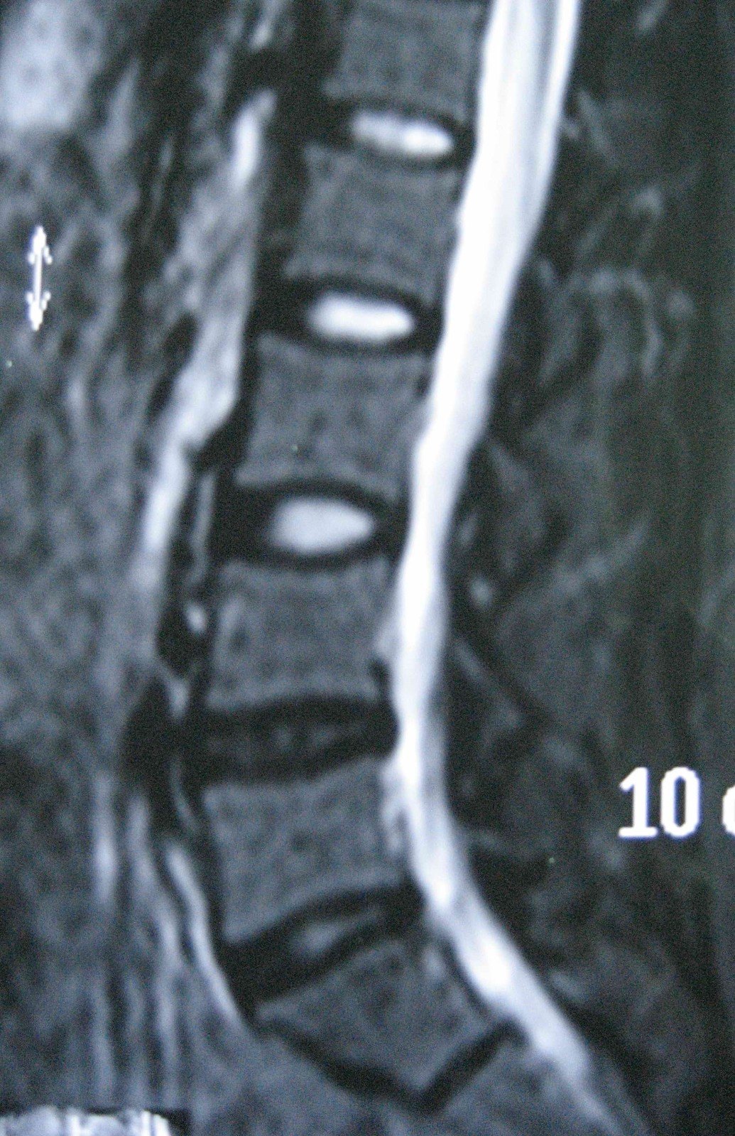 腰椎间盘突出症的微创治疗_腰椎间盘突出切除术_腰椎