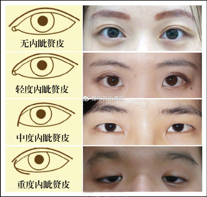 对照一下图片看看你的内眦赘皮类型和程度:4)黑眼珠暴露较少或过多