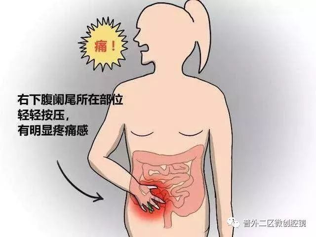 急性阑尾炎的最典型症状是右下腹疼痛,伴有压痛,反跳痛,腹肌紧张.