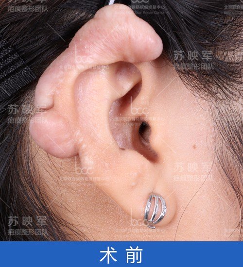 打耳洞结果长出3个"肉疙瘩",耳朵险"毁容"