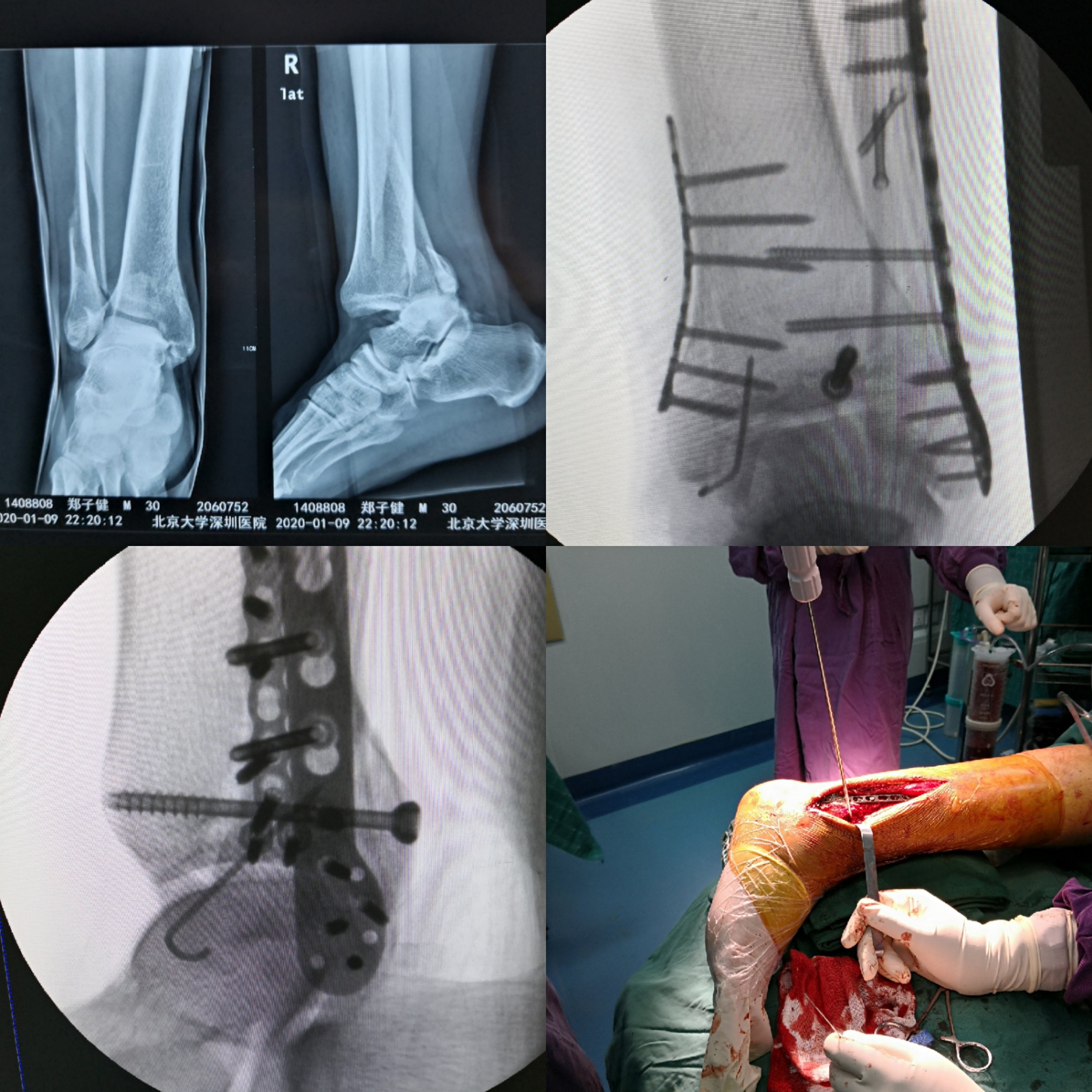 术前检查:踝关节正侧位x光片看力线,三维ct看关节面及骨折细节,踝
