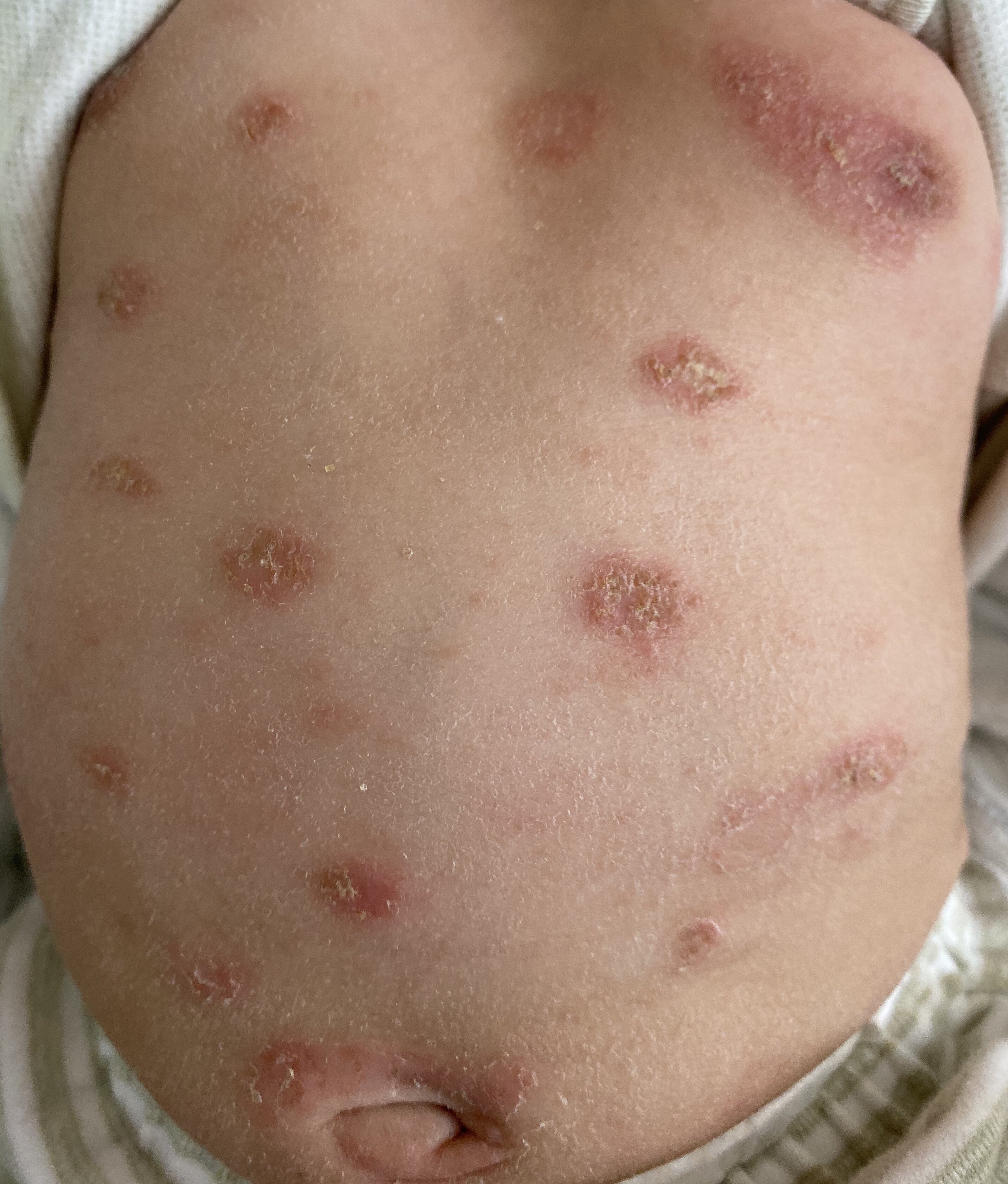 湿疹在不同年龄段皮疹表现都不一样哦!