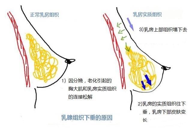 如何预防?_乳房萎缩
