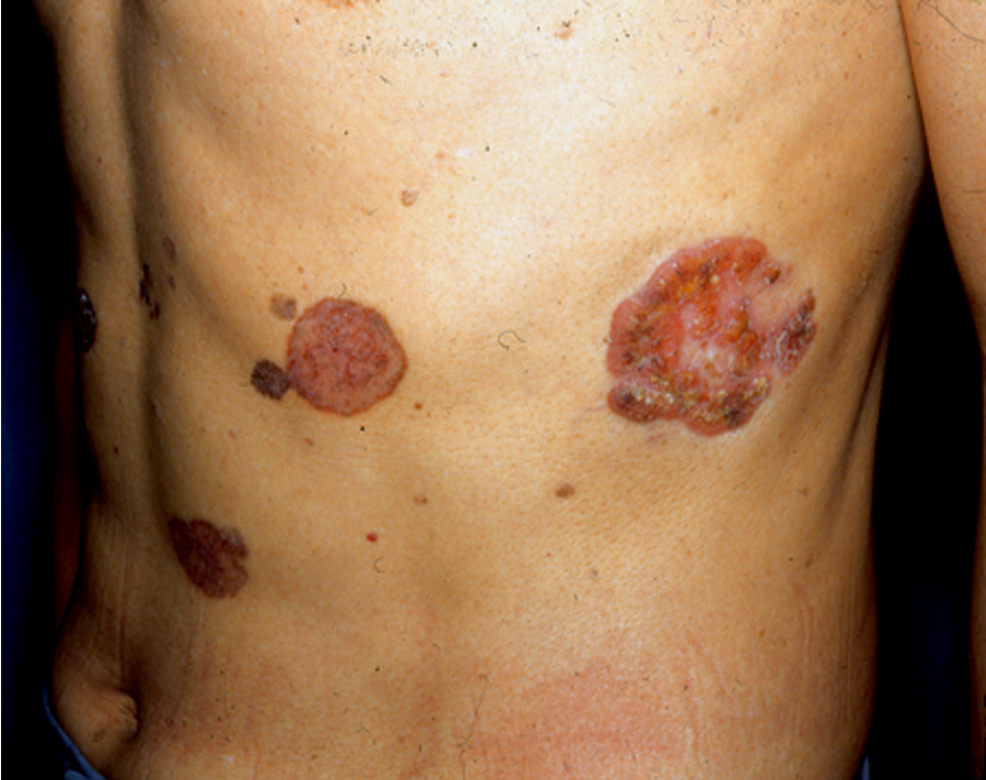 皮肤上持续不消退的小斑块需要警惕鲍温病一种早期鳞状细胞癌