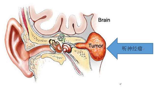 听神经瘤