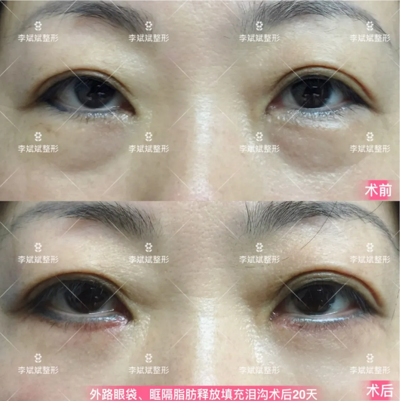 有眼袋泪沟怎么办