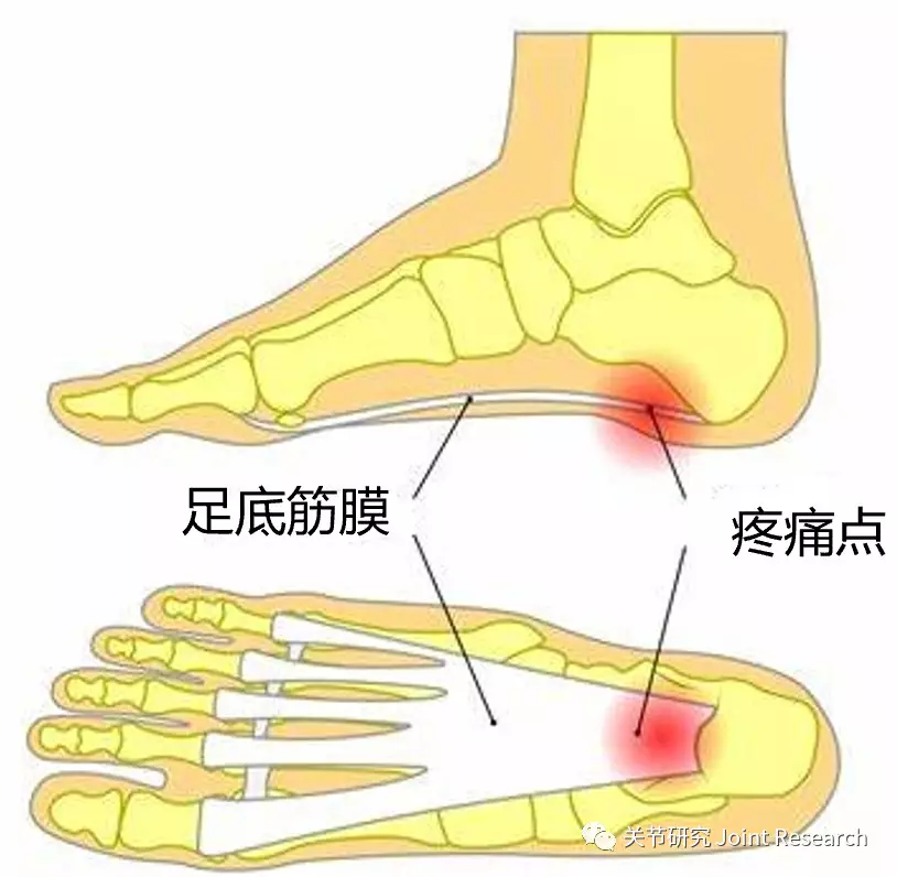 足底板痛之---足底筋膜炎