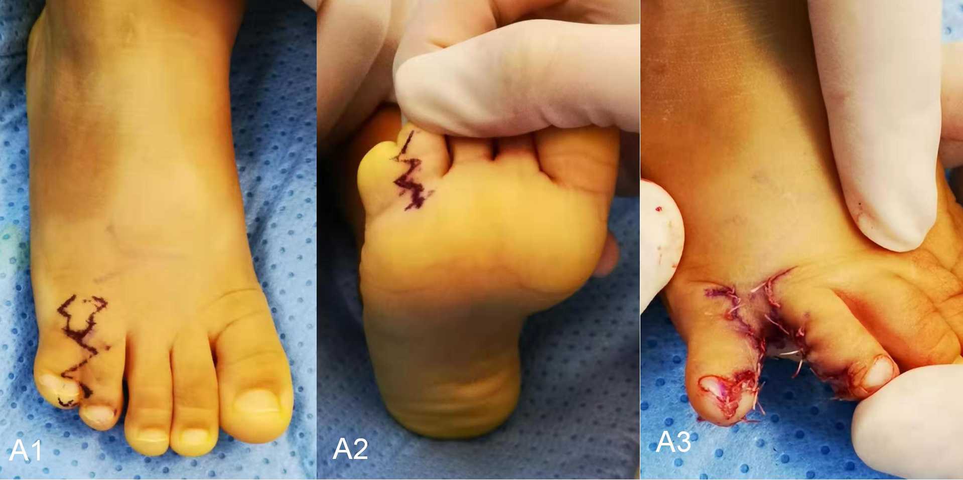 小朋友出生后发现足趾多趾并趾畸形,该怎么办?