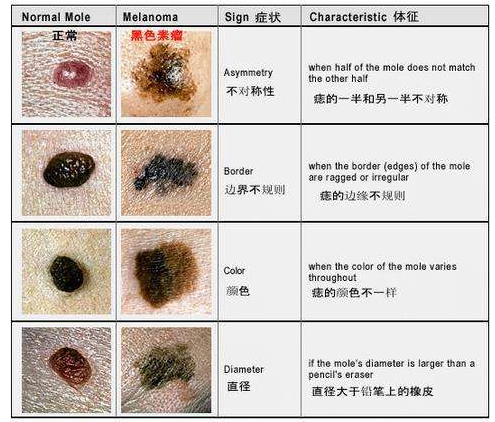 普通色素痣与黑色素瘤鉴别