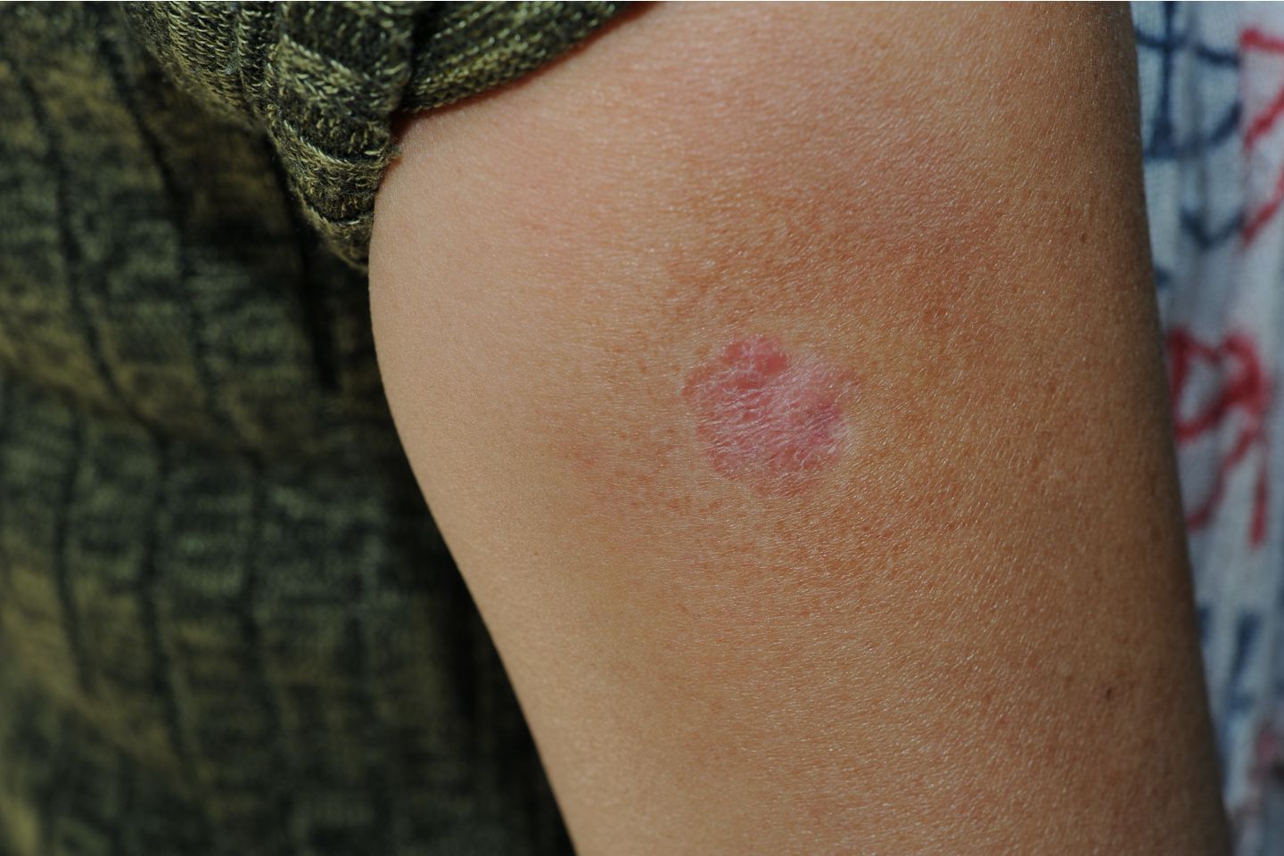 皮肤上持续不消退的小斑块,需要警惕鲍温病——一种早期鳞状细胞癌!