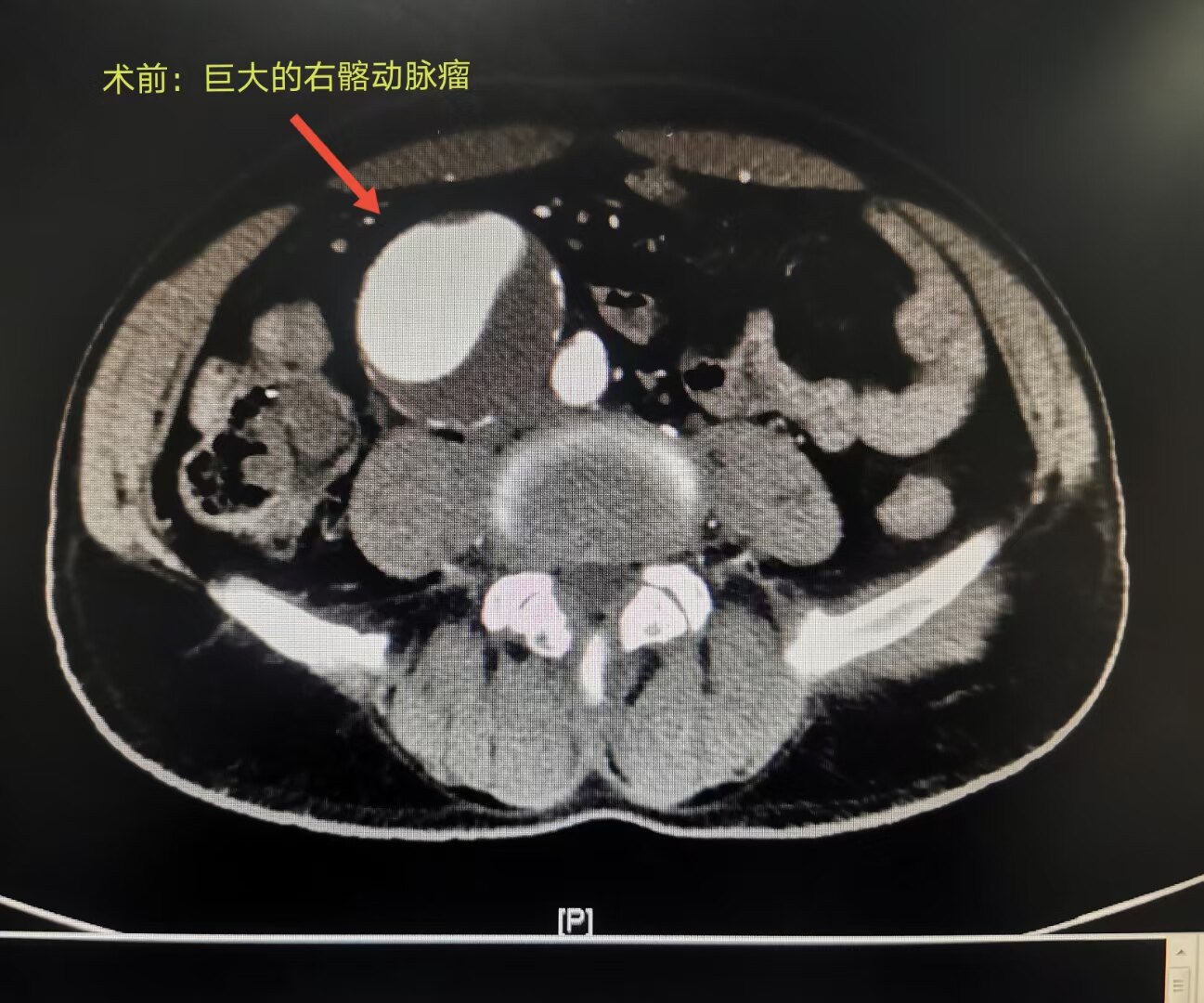 "腿中风",罪魁祸首是肚子里面的巨大右髂动脉瘤