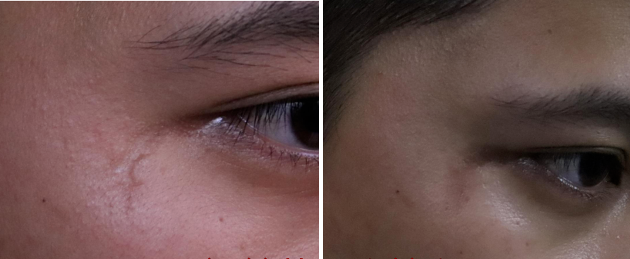 眼角凹陷性瘢痕治疗