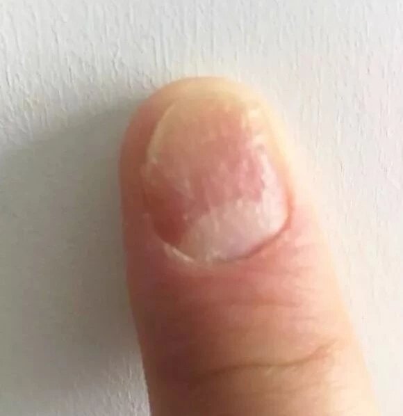银屑病指甲太受伤,很多被误诊