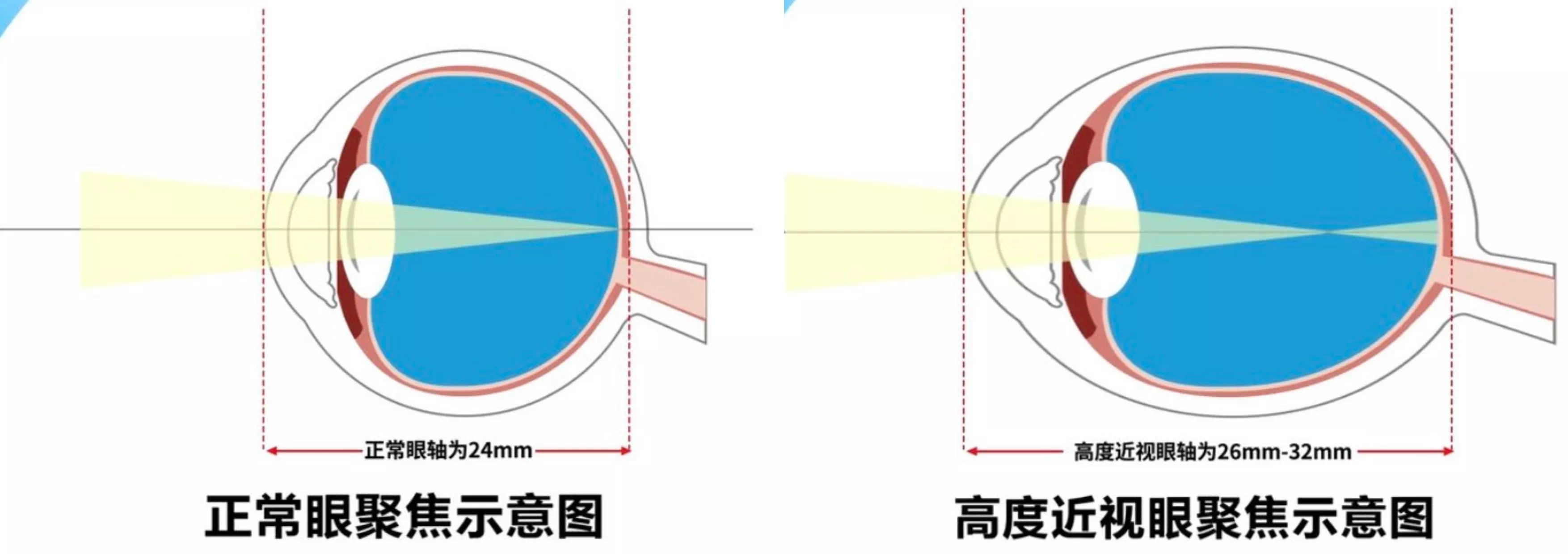 近视600度可能有致盲风险