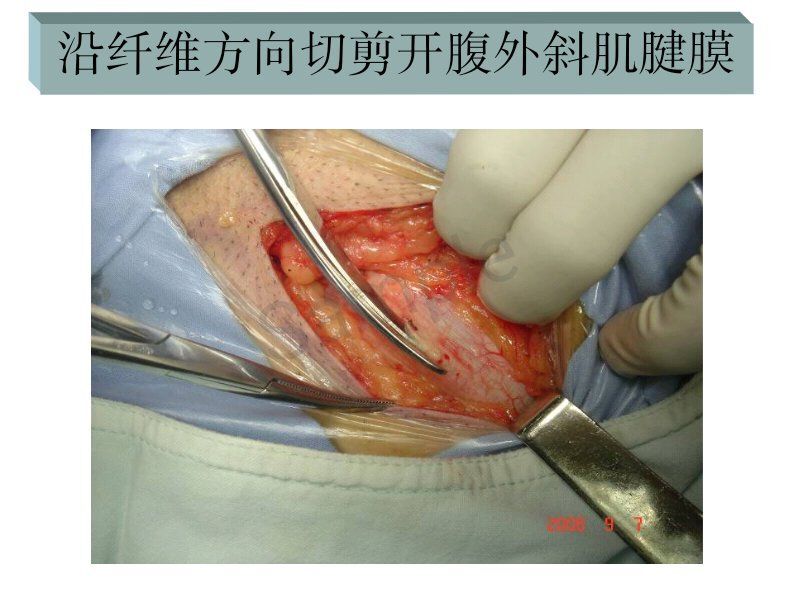 腹股沟疝无张力修补