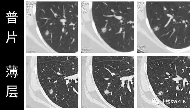 话说肺小结节之普扫胶片与薄层ct