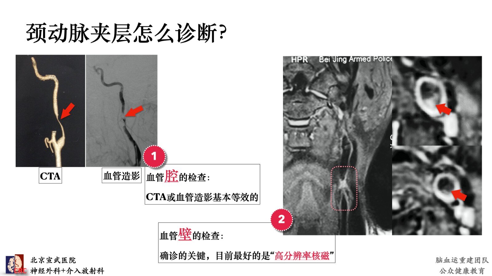 颈动脉夹层,告诉您这个病