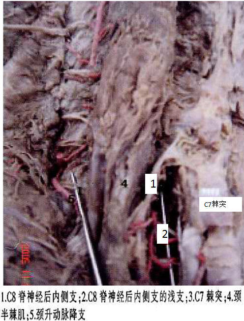 颈38颈神经后内侧支痛的解剖基础