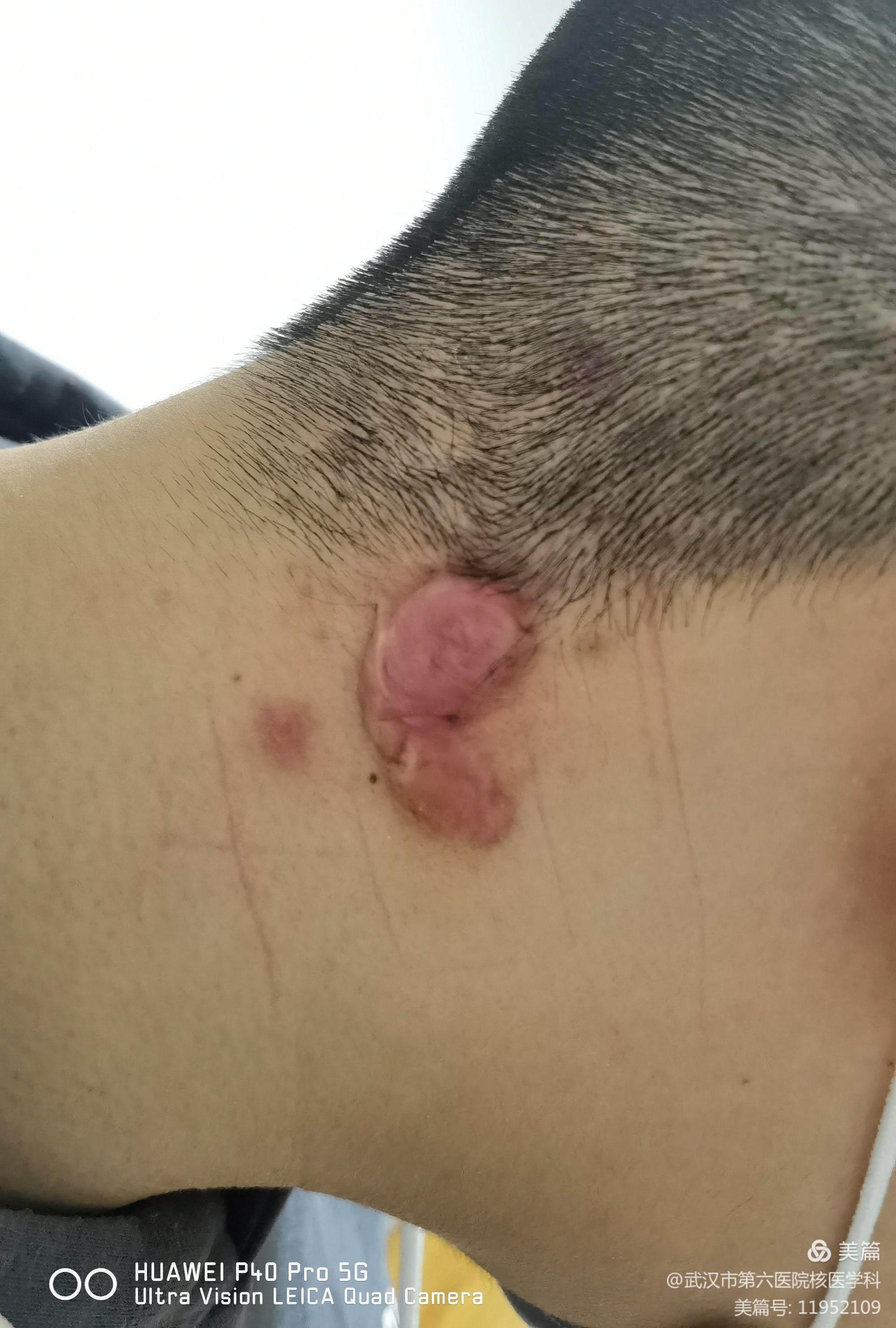 右侧颈项部皮脂腺囊肿术后局部疤痕疙瘩瘢痕疙瘩,俗称疤痕疙瘩,是