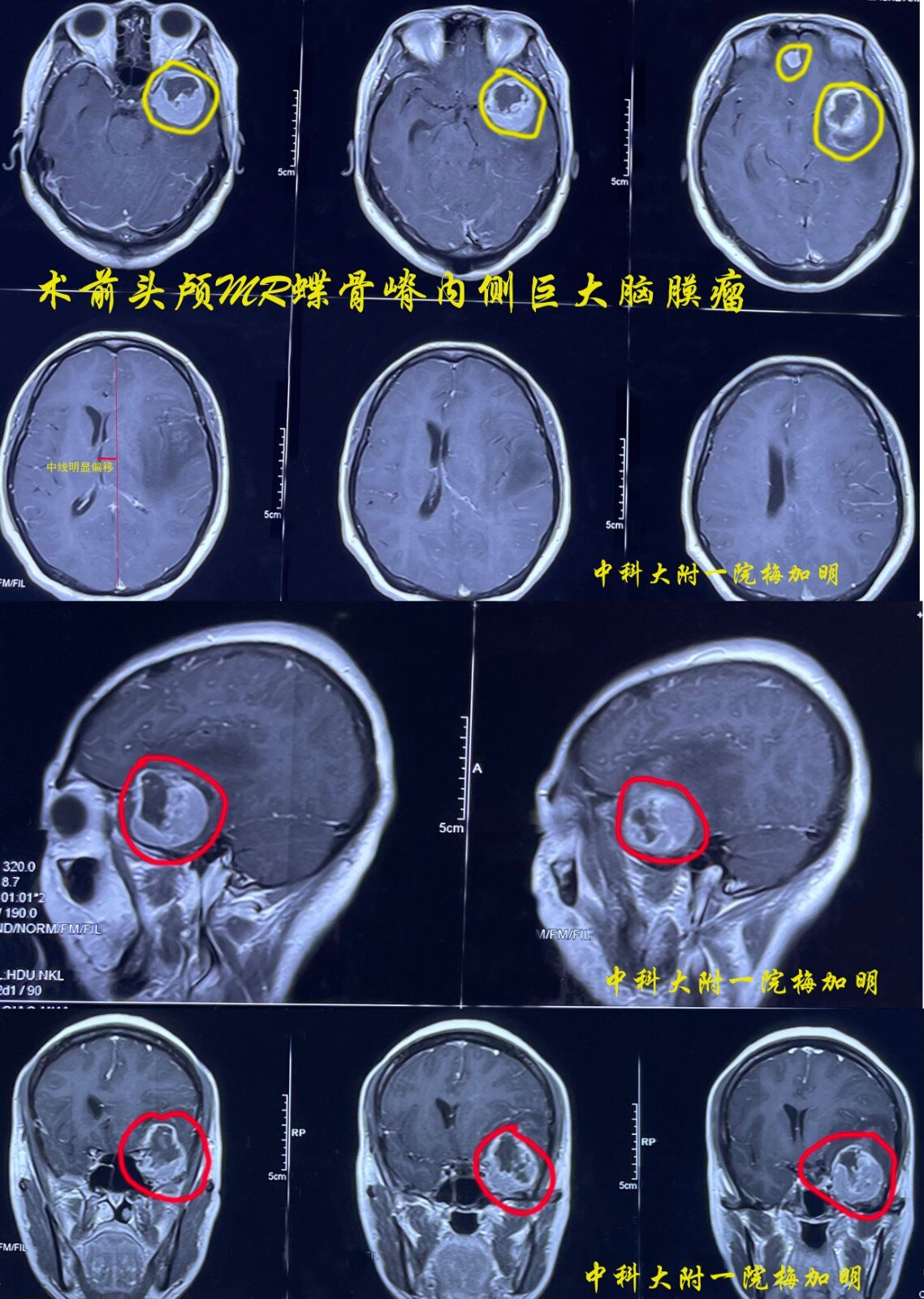 头痛患者的就医经历之二蝶骨嵴内侧巨大脑膜瘤导致剧烈头痛