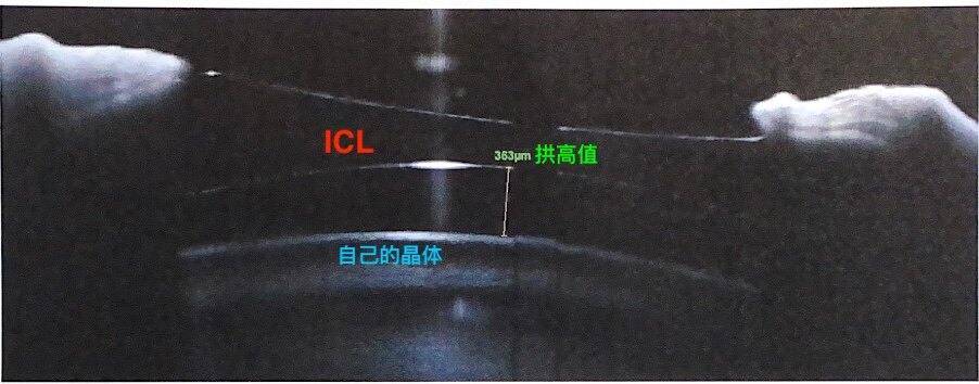 icl手术后相当于眼内放入了隐形眼镜,对以往近视本身导致的青光眼