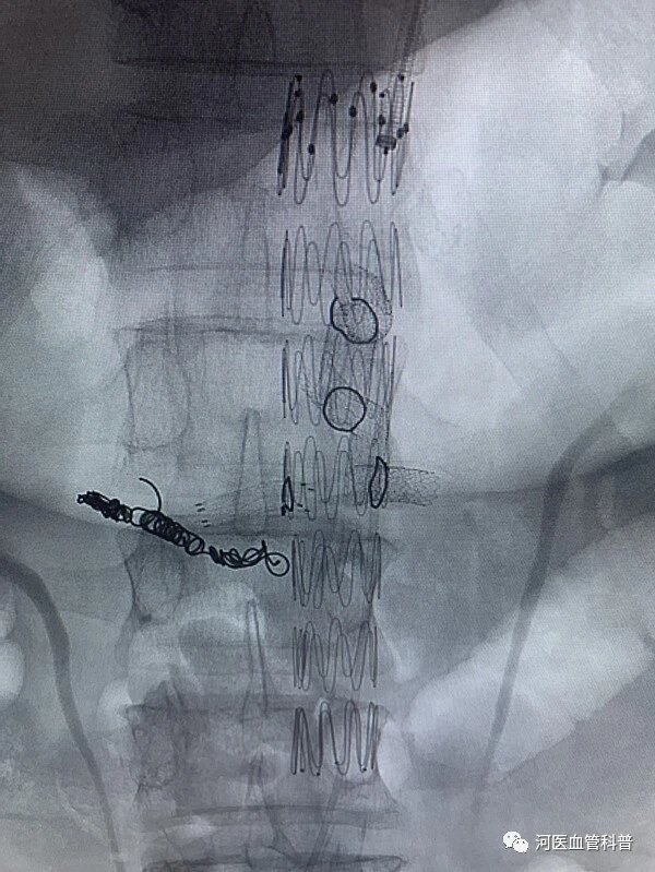 让完全腔内技术发挥到极致腹主动脉支架四开窗