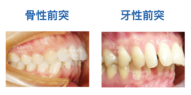 因为牙槽骨前突,笑的时候会伴有露龈笑,下嘴唇外翻,颏唇沟不明显.