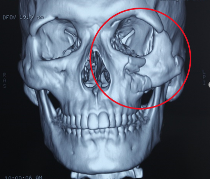外伤之后脸塌了怎么办颧骨颧弓上颌骨骨折