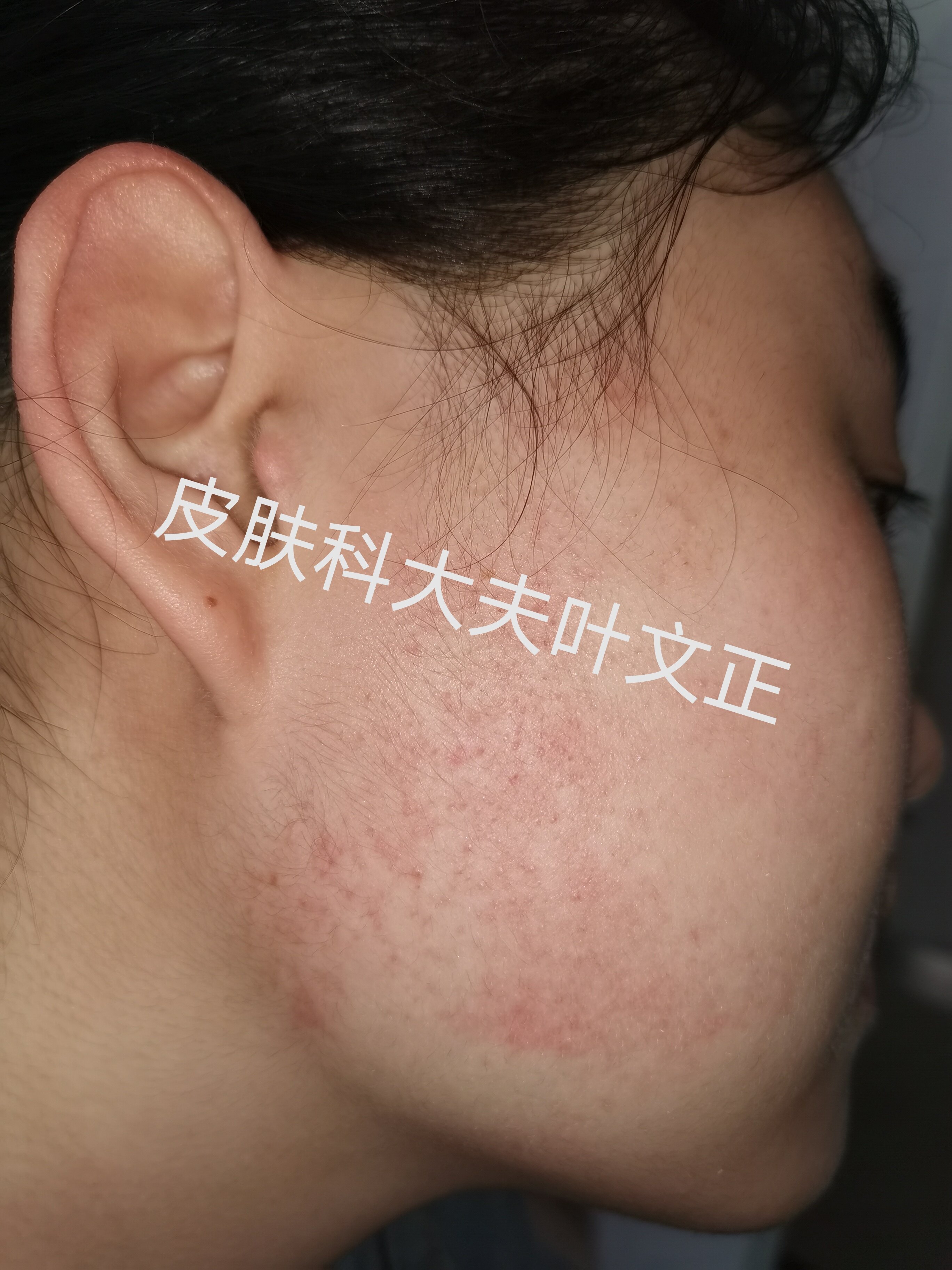 面颈部毛囊性红斑黑变病典型图片