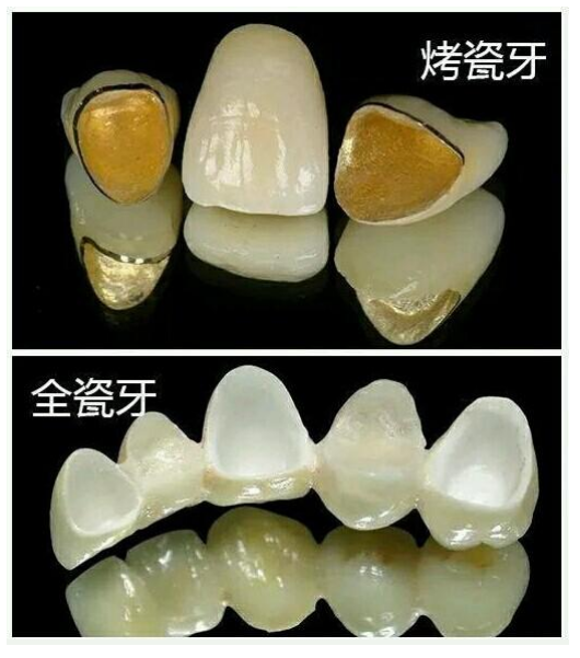 种植牙的牙冠有哪几种材料