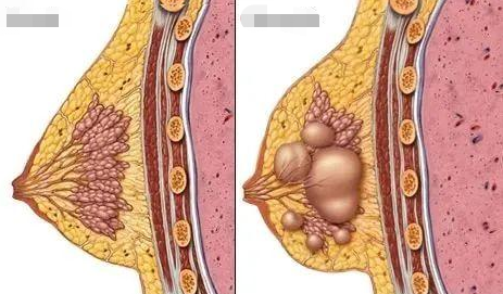 【曾立谈隆胸】有乳腺结节做了隆胸会癌变吗?