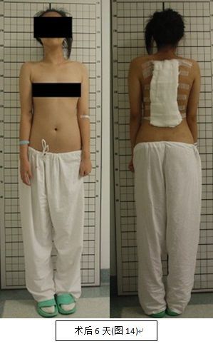 脊柱侧弯