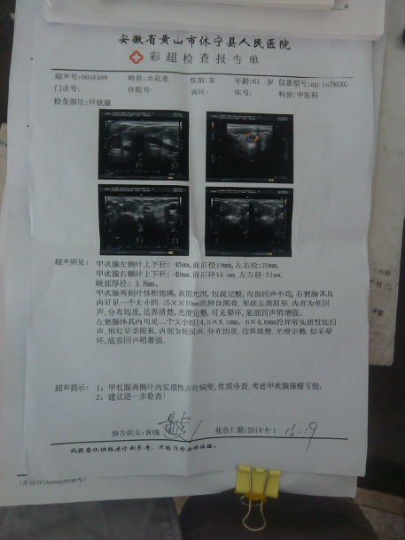 甲状腺肿块甲亢的中医药治疗附病例处方及数月诊疗日记
