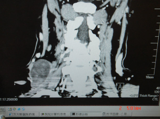 头颈部肿瘤切除臂丛神经鞘瘤