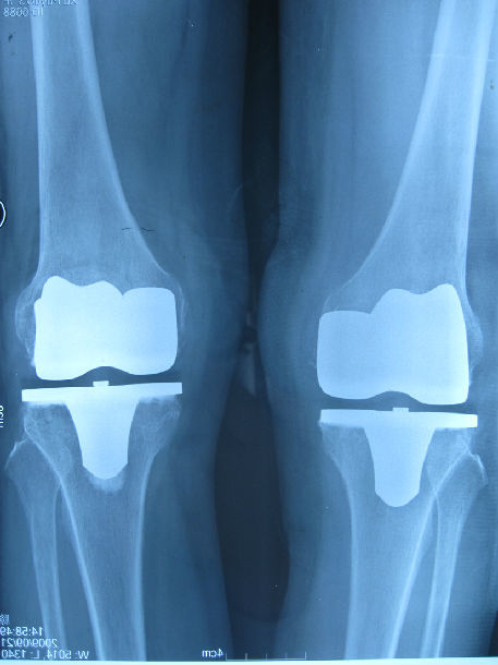 膝关节置换病例 (原创)