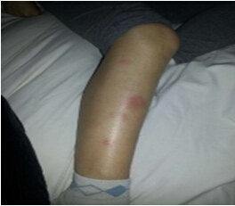 病人的四肢乃至全身的结节红斑,膝,踝特别是脚的结节红斑,多发关节痛