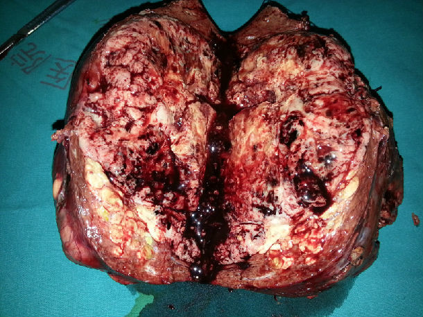 巨块型肝癌不等同于晚期肝癌 (原创)