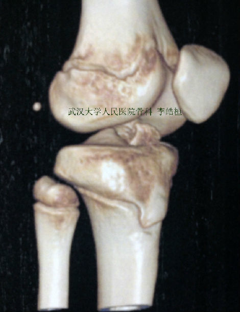 关节镜下胫骨髁间棘撕脱性骨折的复位固定